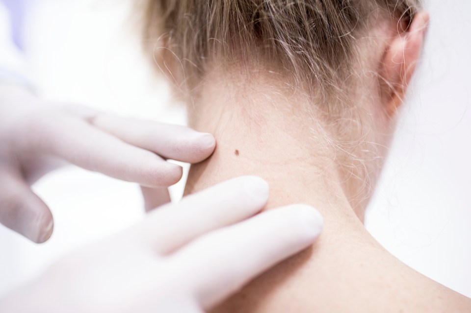 Skin cancer rates have increased by almost a third over the past decade