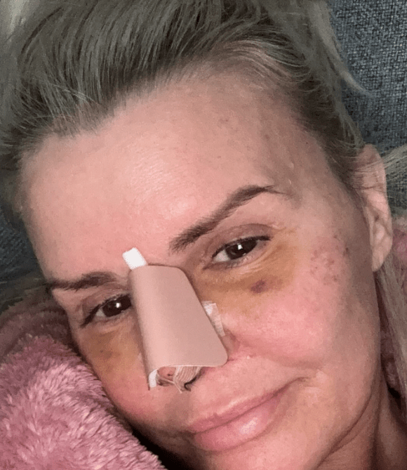 Kerry Katona revealed her bruising after having her nose reconstructed