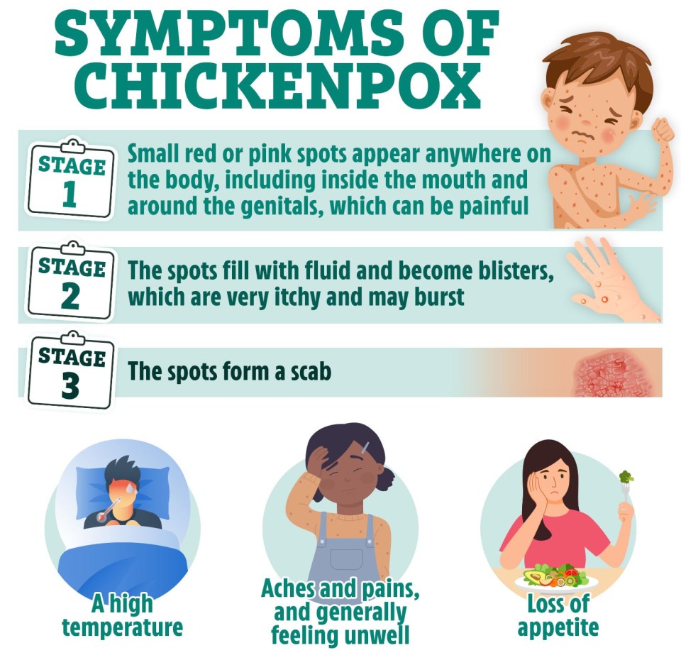 Symptoms of chickenpox – the spots usually appear in three stages