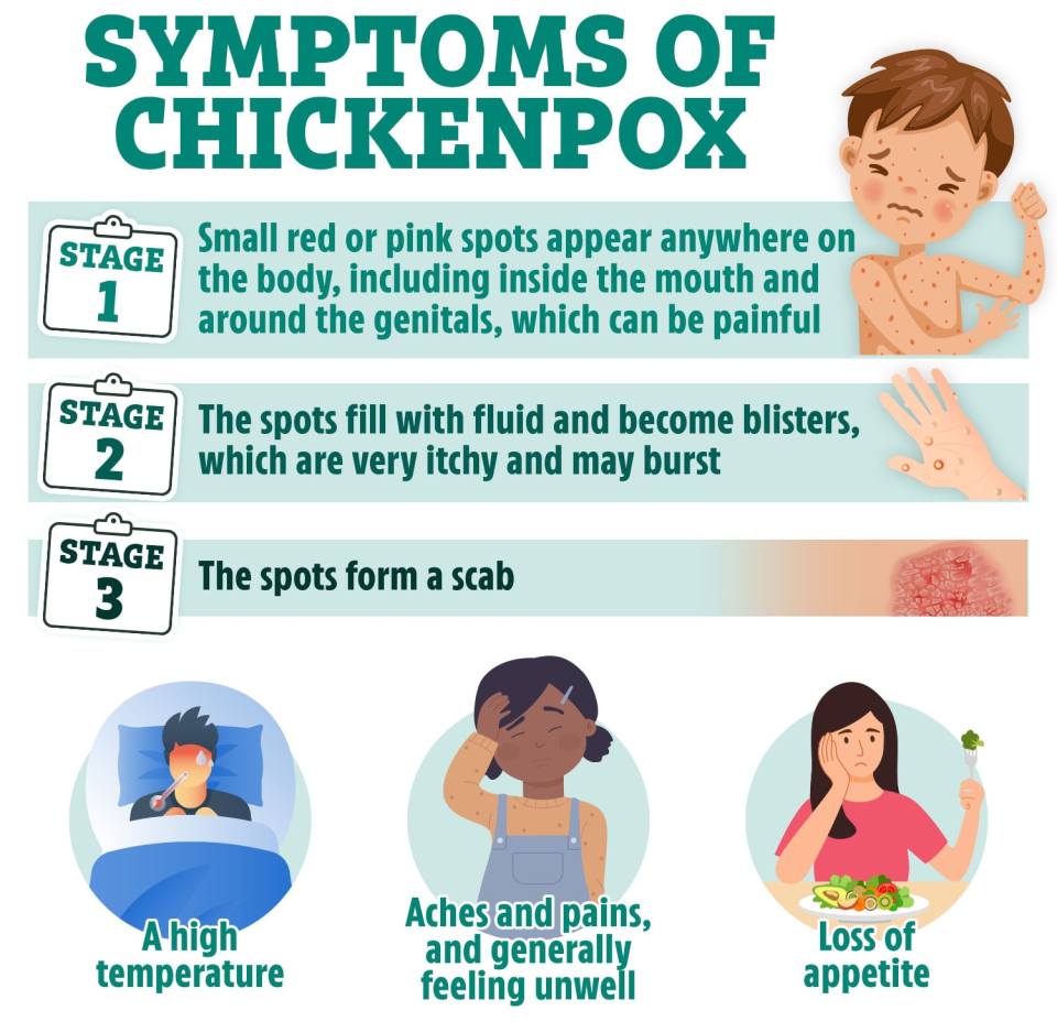 Symptoms of chickenpox - the spots usually appear in three stages