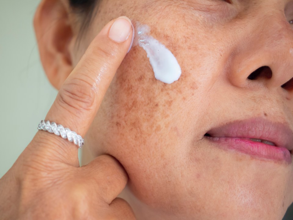 The skin can develop hyperpigmentation with exposure to the sun