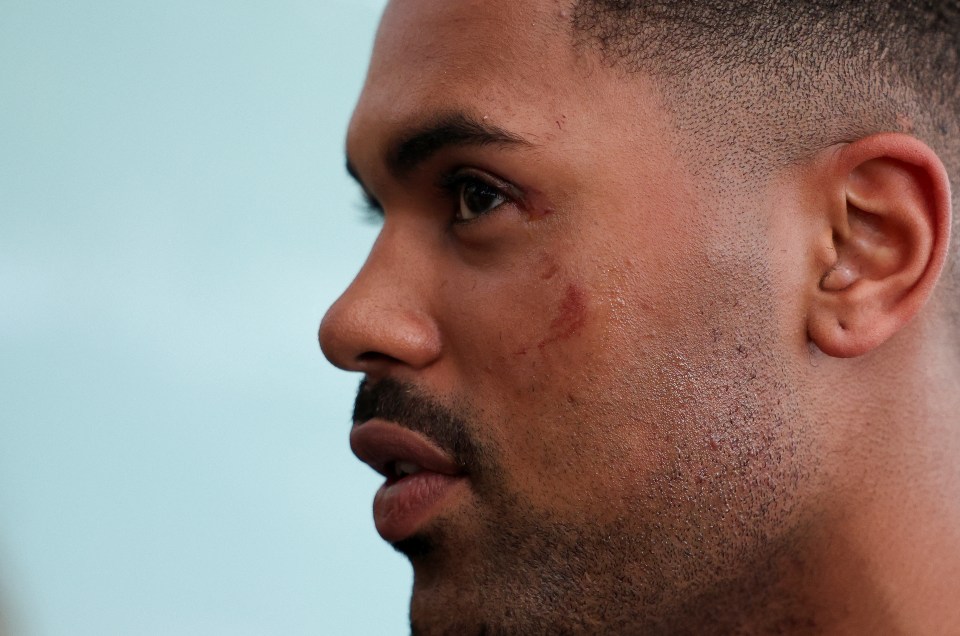 A cut is seen on Josh's cheek as he talks to the media at Samitivej Hospital, in Bangkok