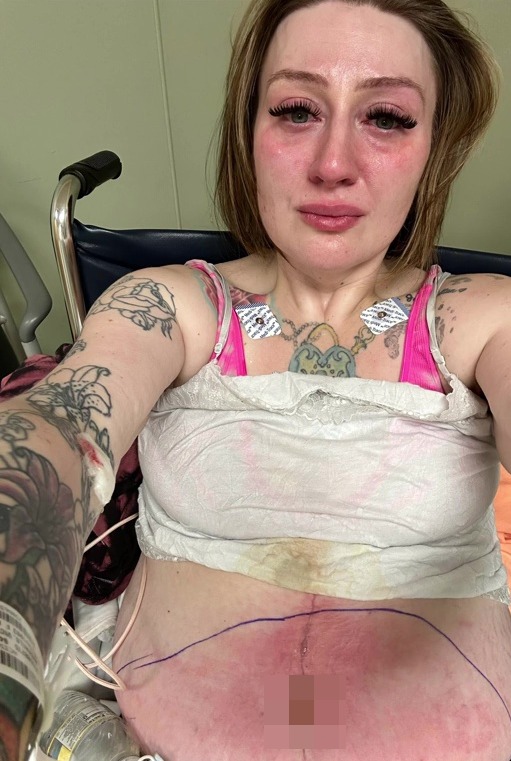 The procedure left her with gaping infected holes in her stomach