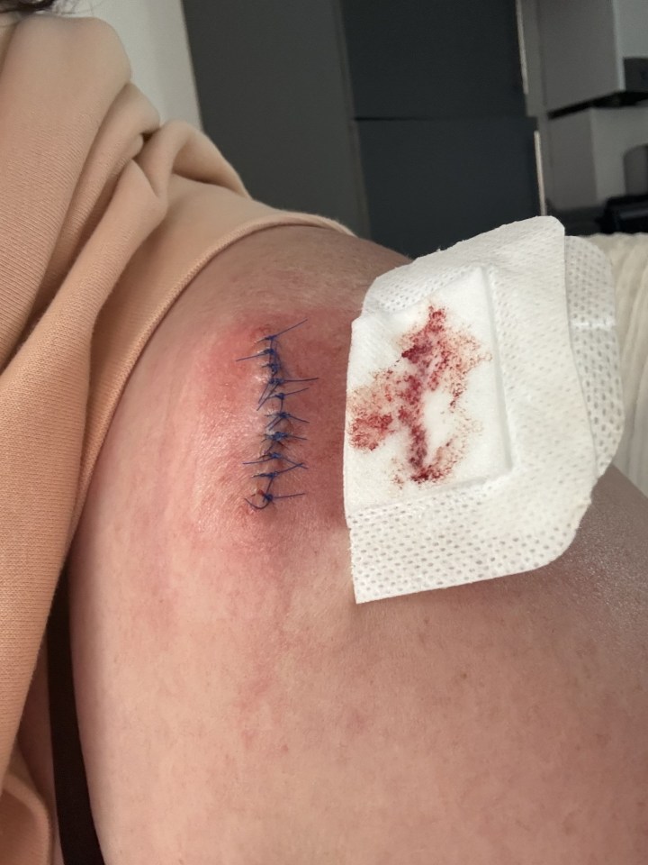 After having the mole removed Rachael says she was diagnosed with melanoma skin cancer