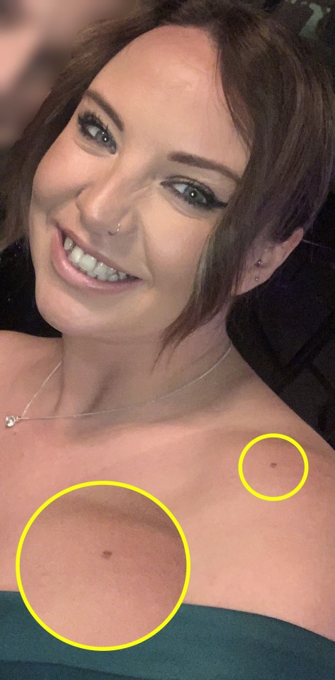 When her friend spotted an irregular ‘raised’ mole on her shoulder she checked it out