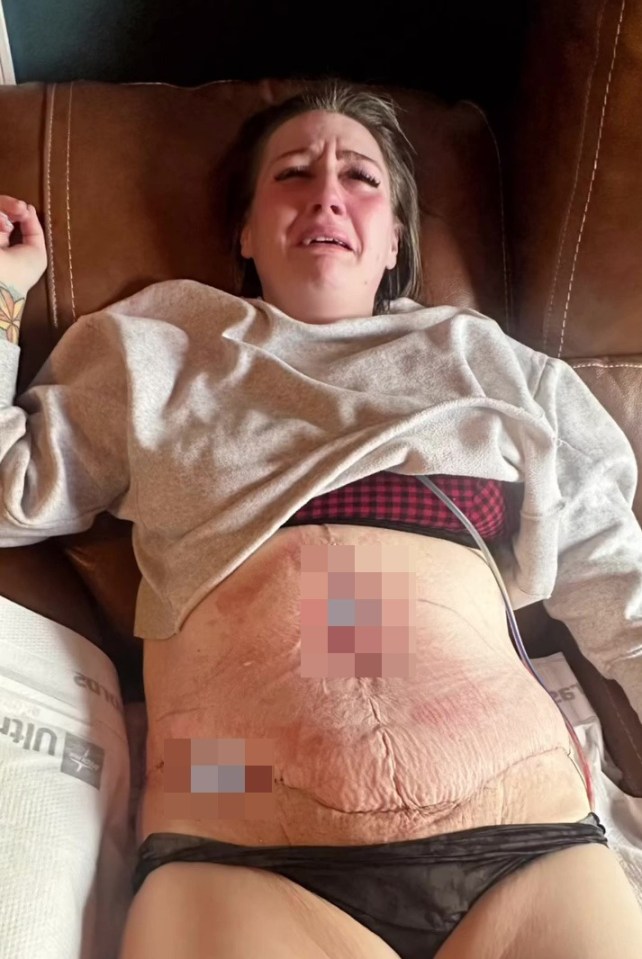 She suffered a horrific botched tummy tuck operation