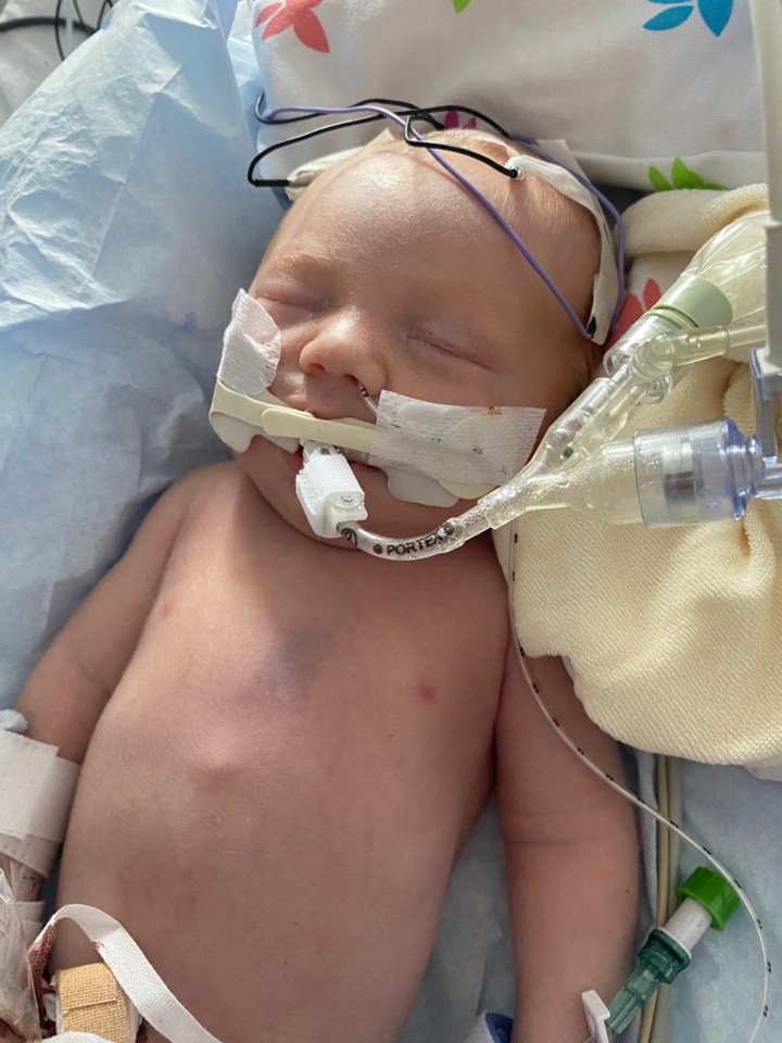 Alexander was born via C-section and didn't have a beating heart. He was taken to NICU