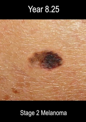 Stage 2 melanomas are usually thicker than stage 1 but have not spread