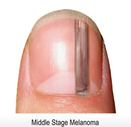 Cancer that grows under the nails is called subungual melonoma.