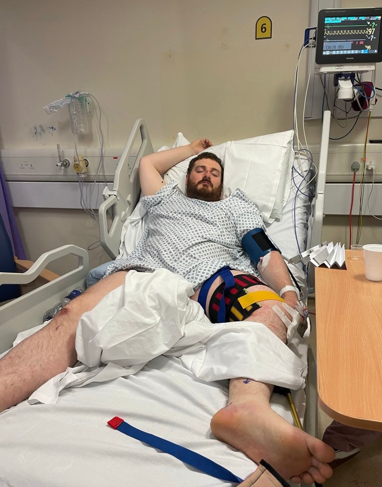 Adam spent two weeks in hospital and needed an operation to insert a metal rod into his mangled left leg