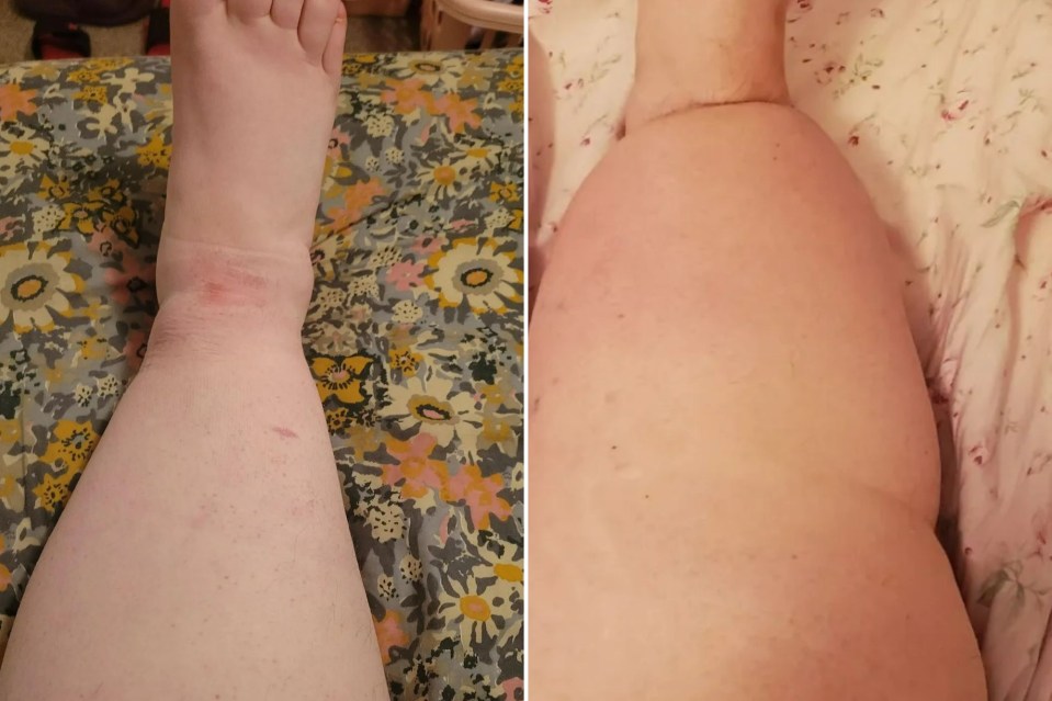 Shannon’s leg with compression pictured on the left, her leg affected by swelling on the right