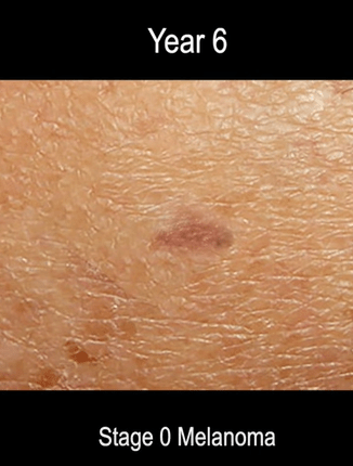 Put together by Dr Christopher Chang, the AI generated video shows the different stages of melanoma – from 0 to 4