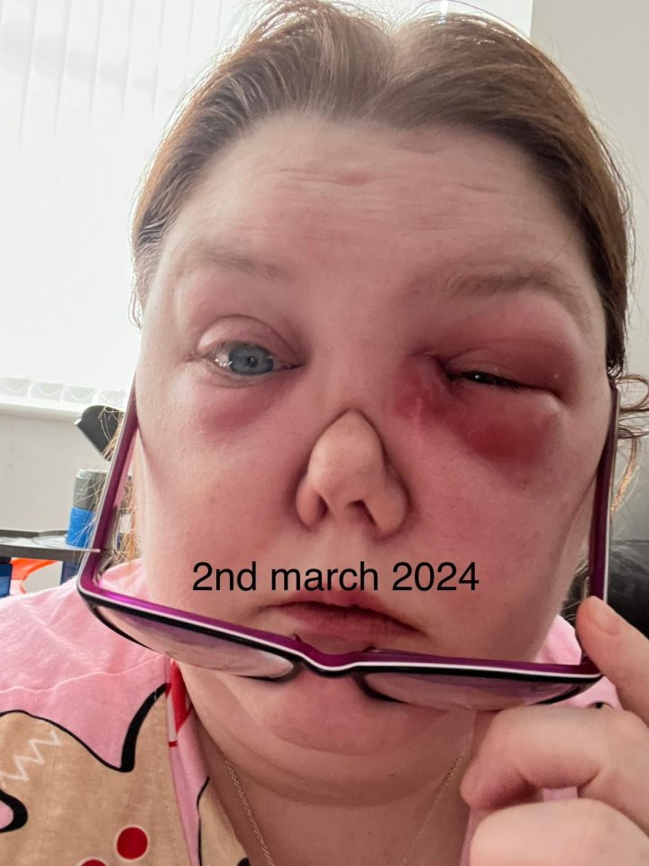 Amanda was diagnosed with granulomatosis with polyangiitis which causes inflammation of the blood vessels in her face