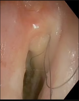 The black wiry hairs growing in the man’s throat