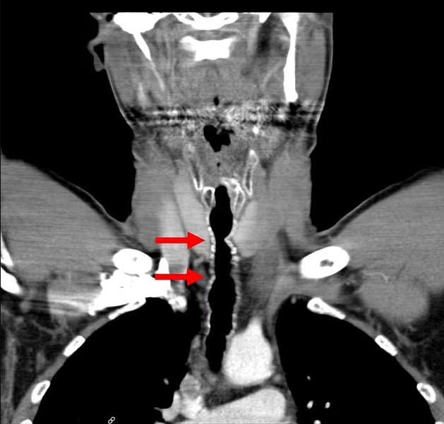 A scan of the man’s throat, with the arrows pointing to places where the hairs were found