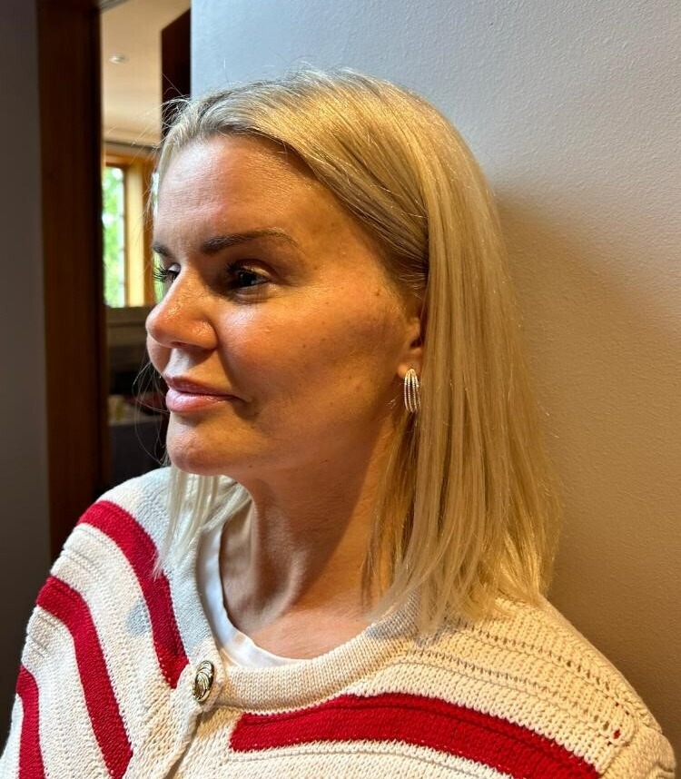 Kerry Katona exclusively shared photos of her nose after the surgery