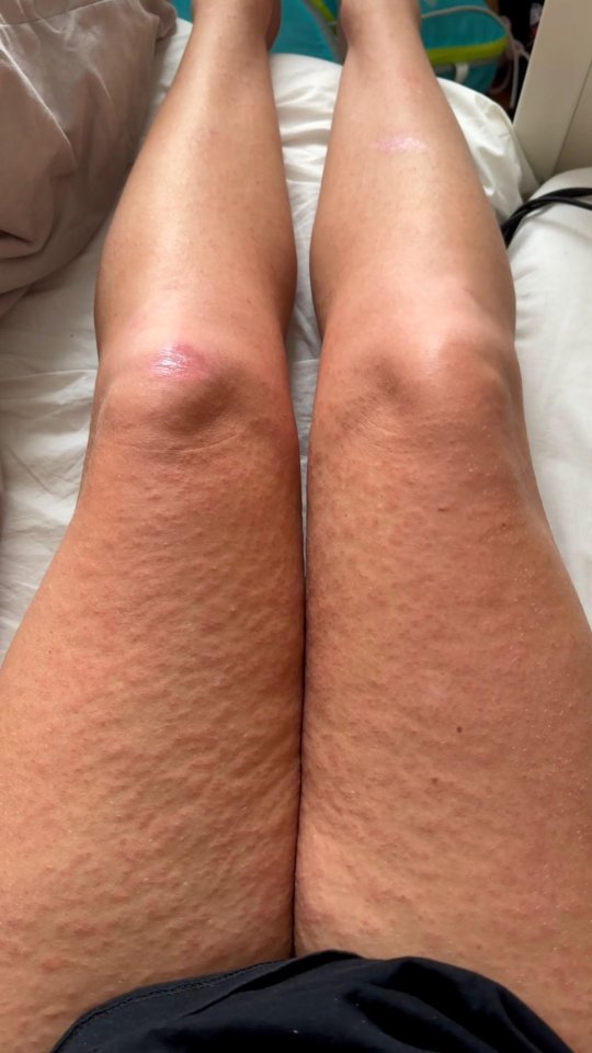 She started with flu-like symptoms then developed a rash all over her body