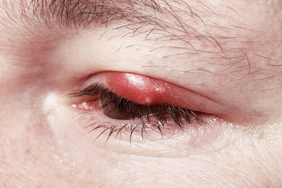 Hay fever can make your peeper more vulnerable to infections like styes