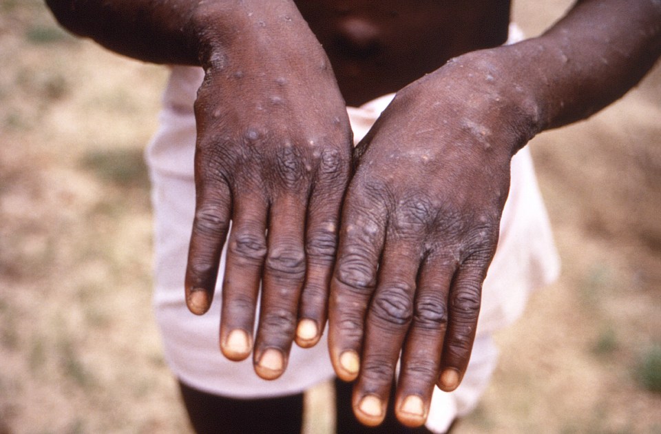 Mpox can cause chickenpox-like rashes and lesions