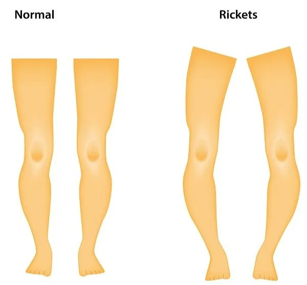 A surge in rickets, which causes bone deformities in children, has been recorded in certain parts of the country