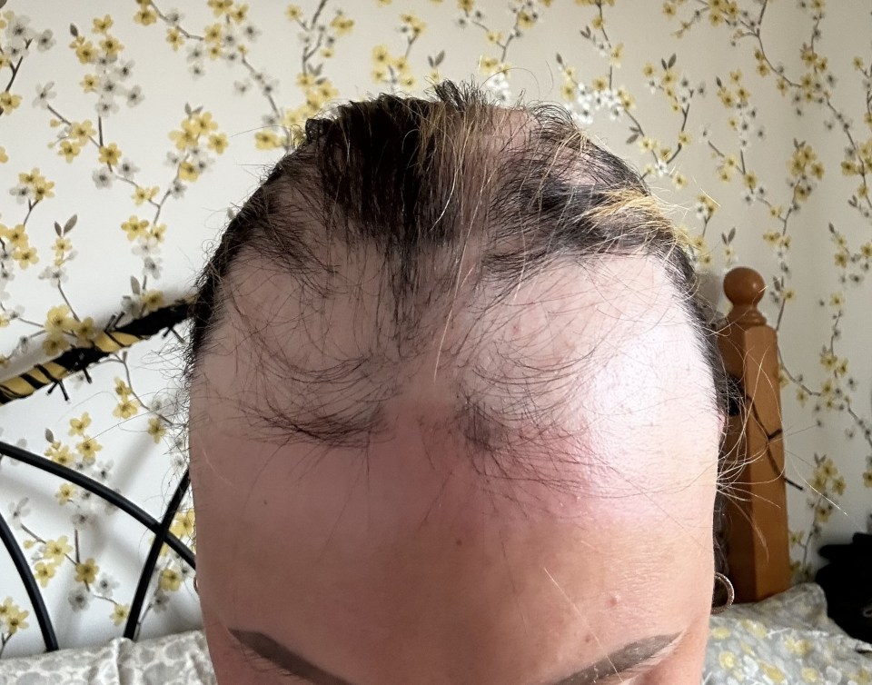 Huge bald patches appeared on her head soon after leaving hospital