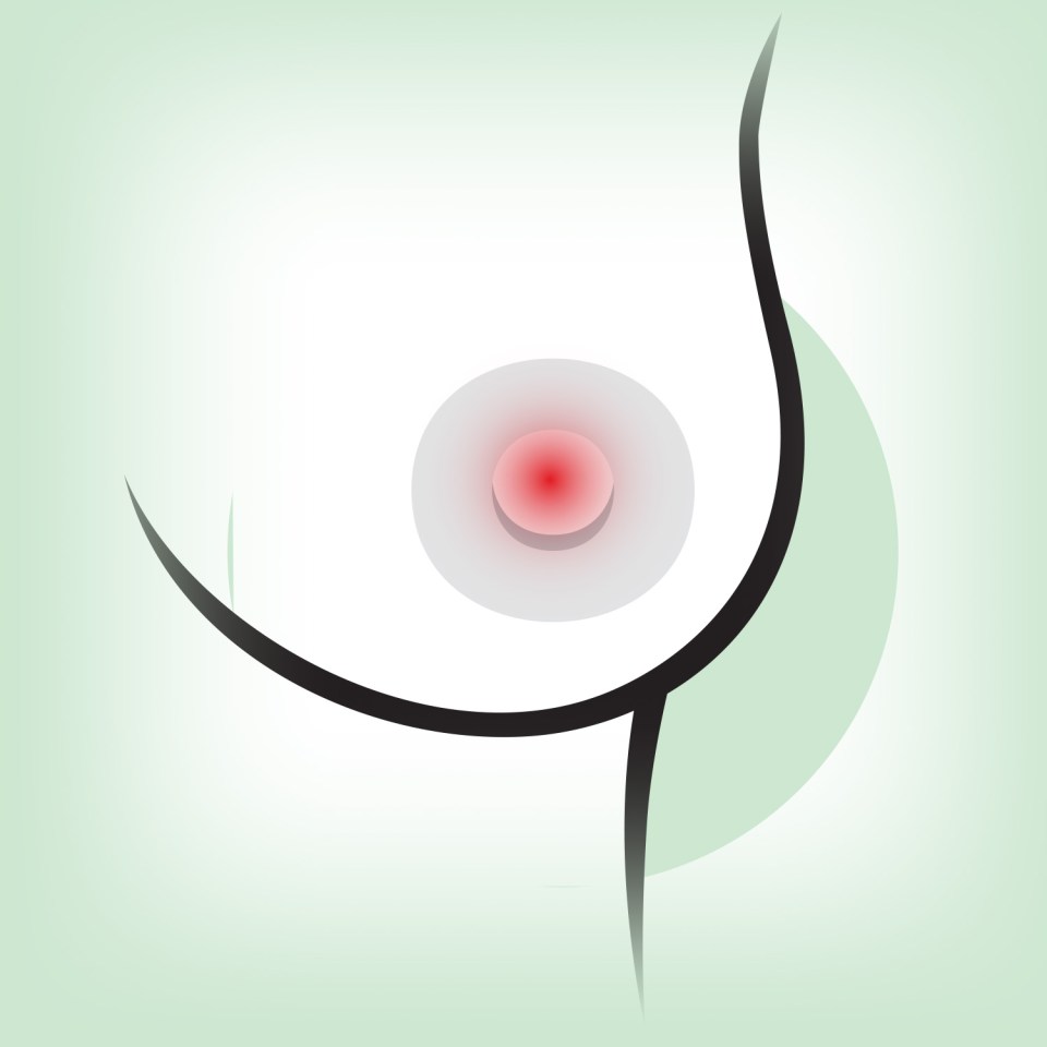 With Paget’s eczema-like symptoms appear on one nipple and may extend to the areola.