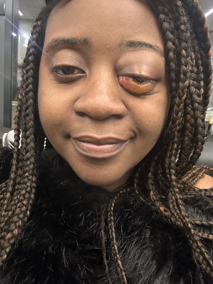 She knew it wasn't conjunctivitis or a stye when her eye began bulging out of its socket