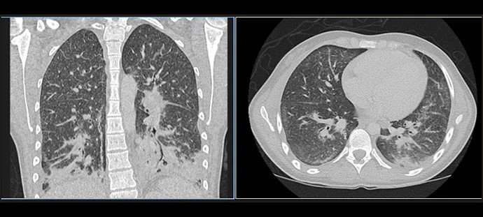 A woman's lung's looked like 'ground glass' due to damage caused by vaping