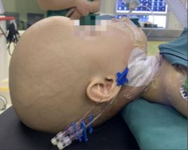 A one-year-old girl with an abnormally large head had a foetus growing in her skull