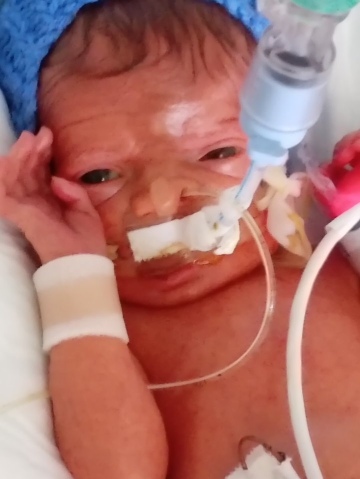 Uzziah Bowman was born with epidermolysis bullosa