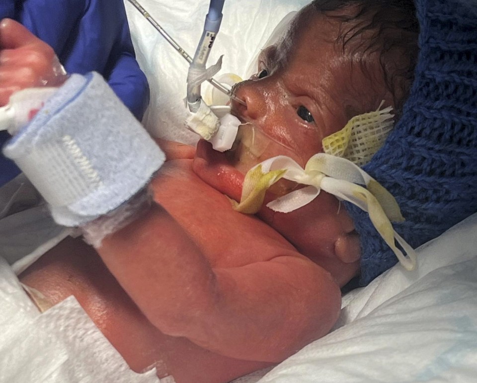 The baby’s skin is left so fragile by the condition his parents can’t hold him