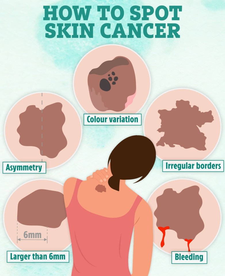 a woman 's back is shown in a poster about how to spot skin cancer