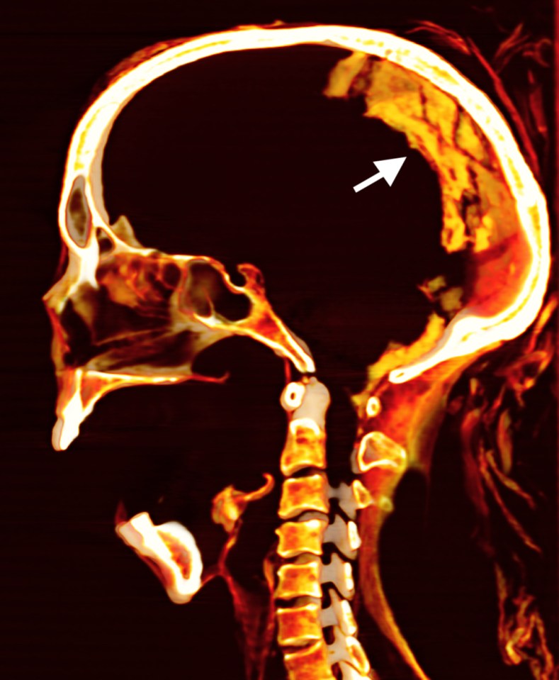 CT scan of the skull of the mummy showing her jaw