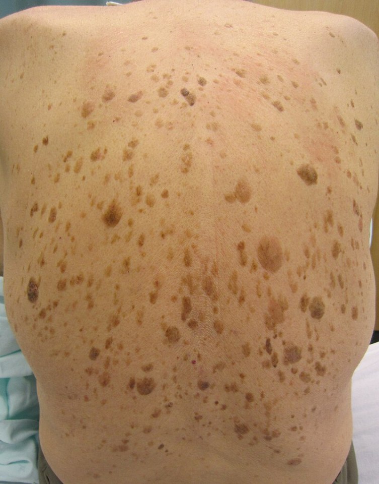 A reader wants to know how she can tackle the lesions caused by seborrhoeic keratosis