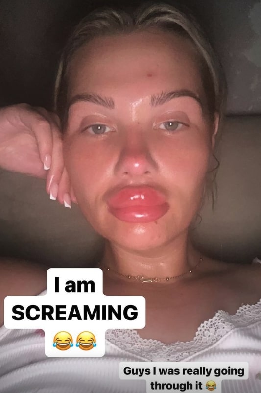 Shaughna Phillips has revealed her huge swollen lips