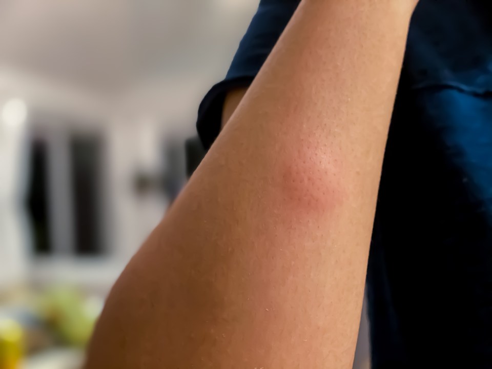 a close up of a person 's arm with a red spot on it