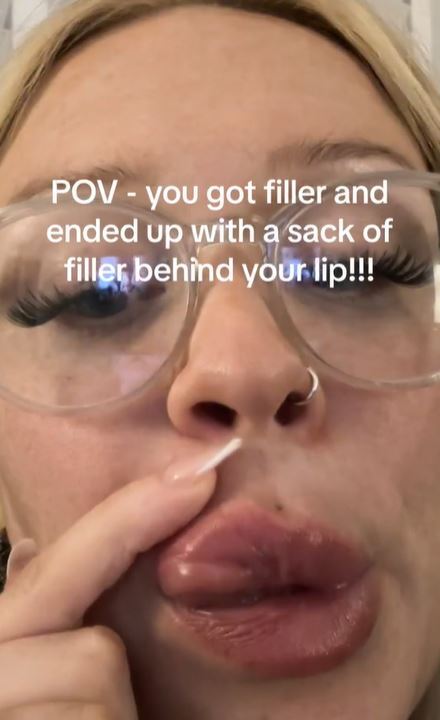 A beauty has warned against getting filler after it left her having a sack behind her lip