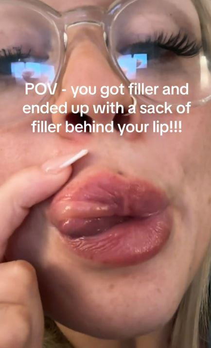 The video has gone viral with many beauty fans concerned about the condition of her lip