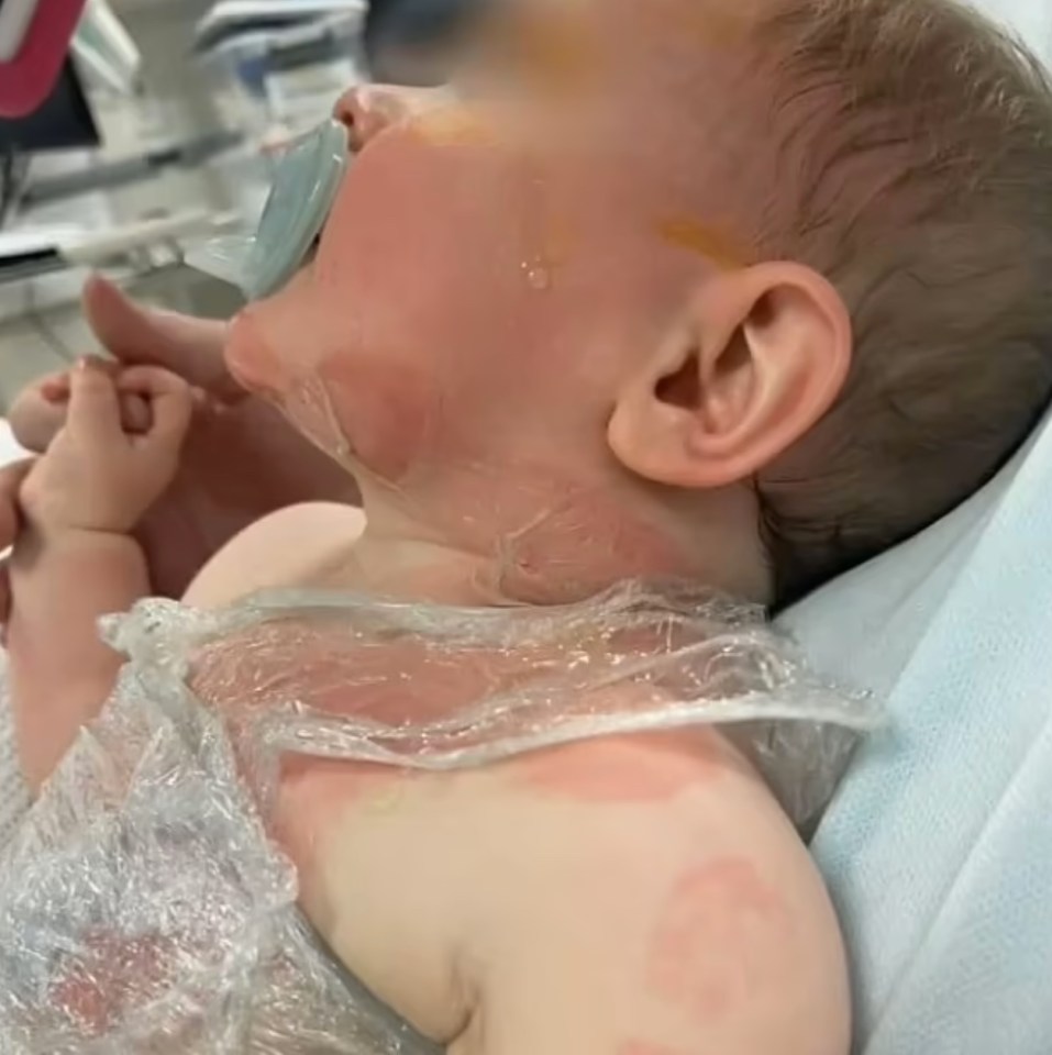 The nine-month-old was rushed to Queensland Children's Hospital where he underwent emergency surgery