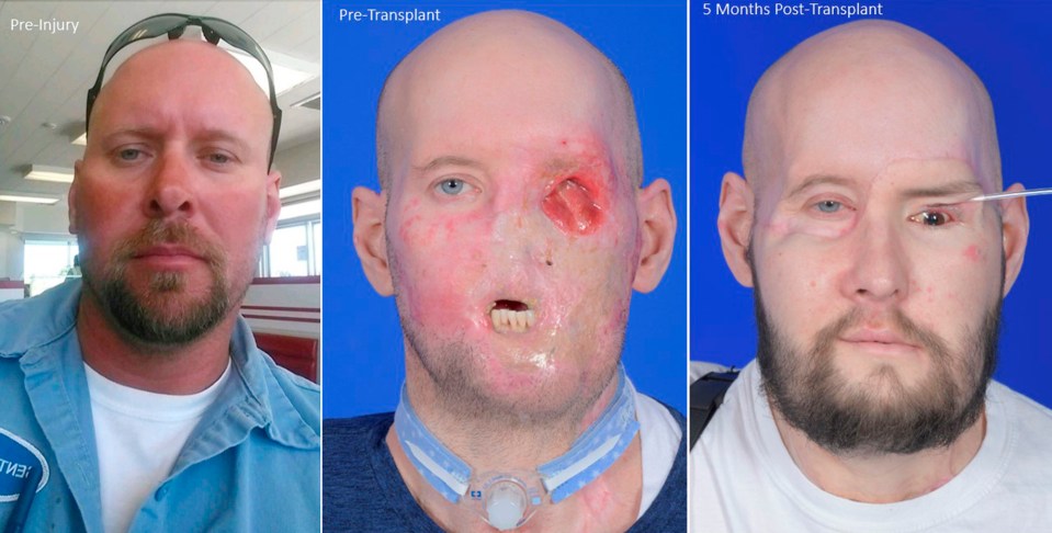 a man 's face is shown before and after a face transplant