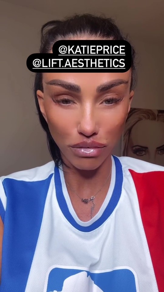 Katie Price revealed she underwent more lip filler on Wednesday