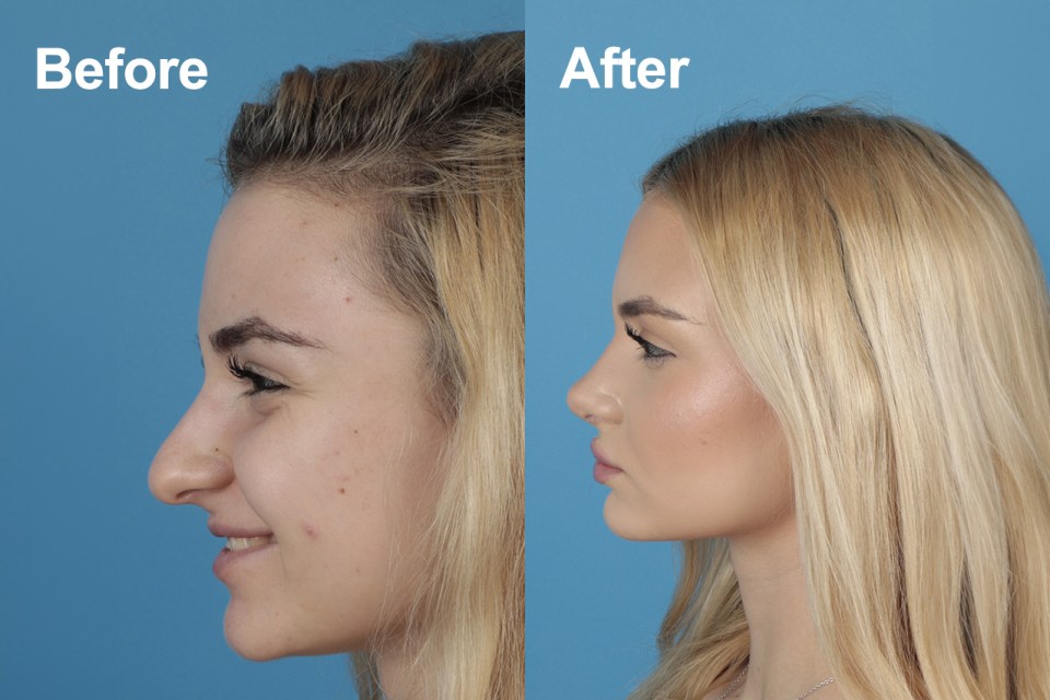 a before and after photo of a woman 's face