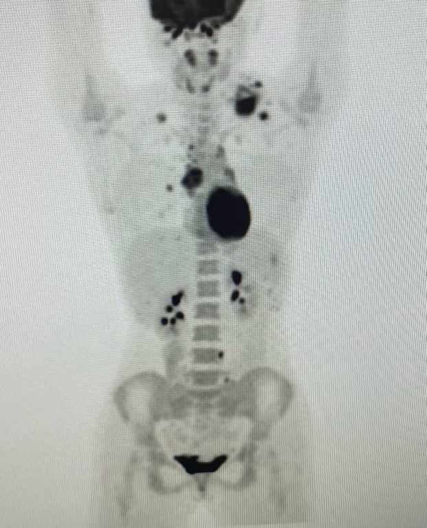 A scan showing how her cancer had spread to her lung and spleen