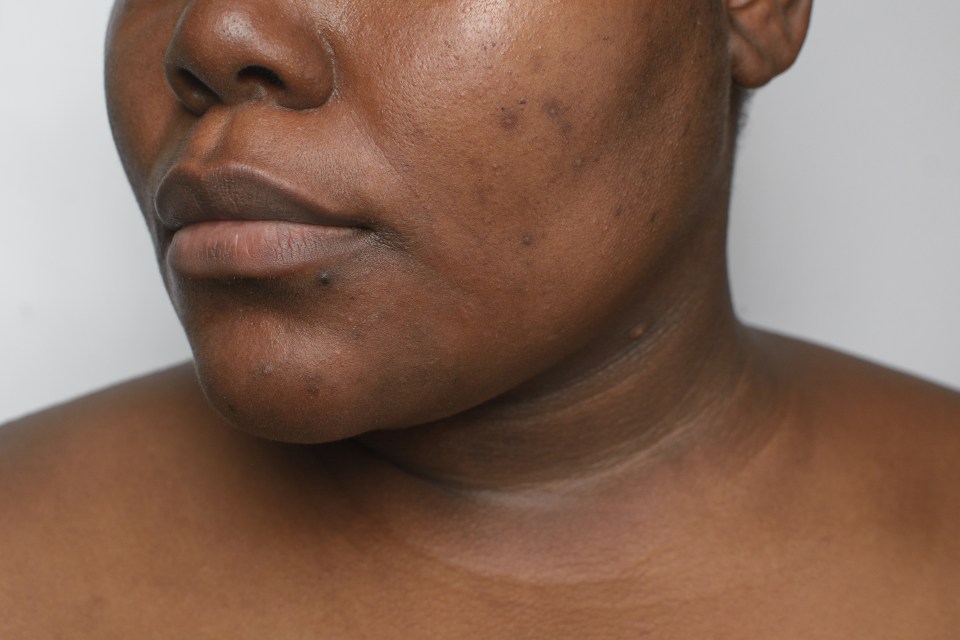 Hyperpigmentation is the result of excess melanin production