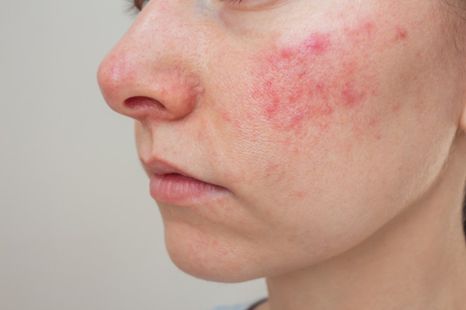 a close up of a woman 's face with red spots