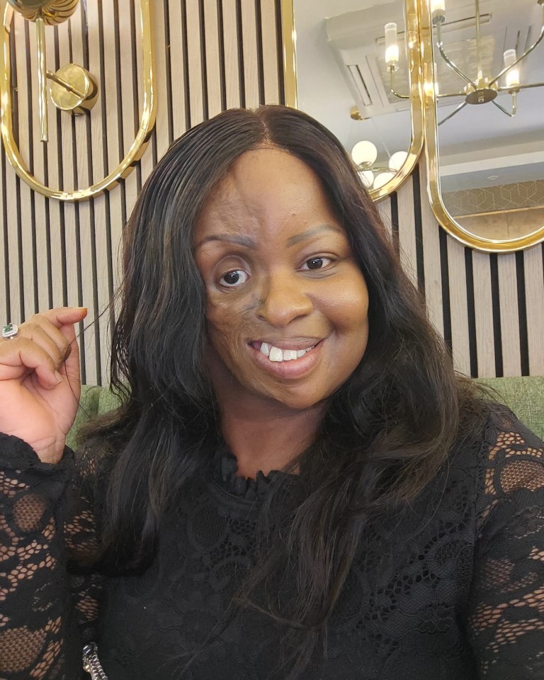 Gillian Kgotla, 29, watched her face change from teenage years