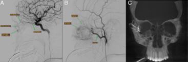 They found that an arteriovenous malformation was the cause of his bleeding