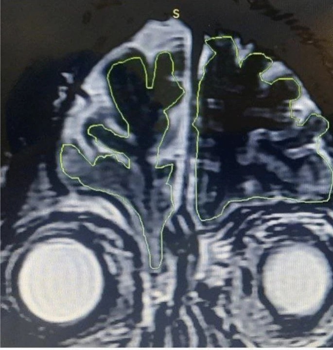 An MRI scan reveals brain tissue (on the left) protruding through the skull into the nasal cavity