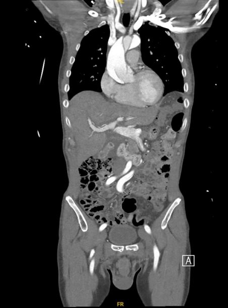 A man, 59, suffered a tear to his artery after masturbating