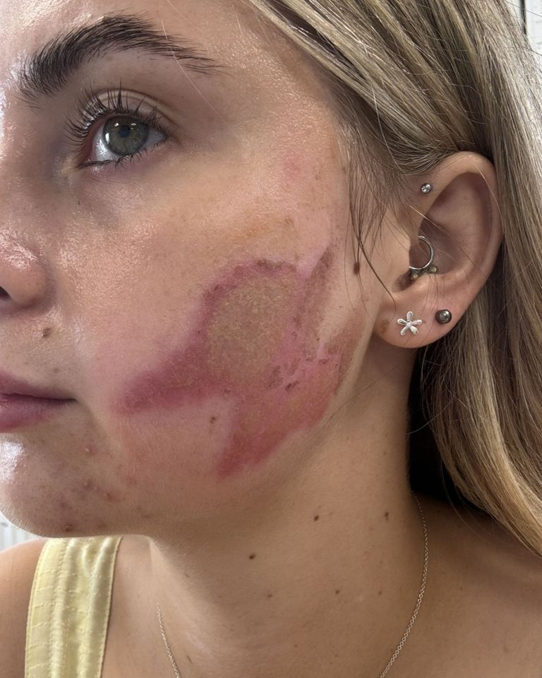 She said her skin was weeping, purple and swollen the day after her procedure